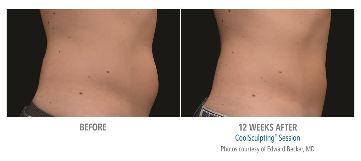 CoolSculpting by Zeltiq - Non-Surgical Fat Reduction - Bronx