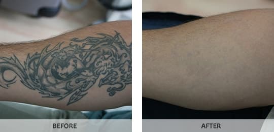 Our Picosure by Cynosure is the best laser technology for tattoo remov... |  TikTok