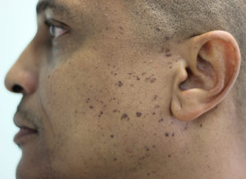 Brown age spots removal male before 1