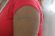 Laser tattoo removal female after 3