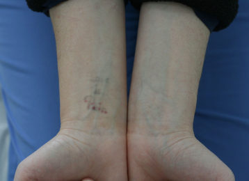 Laser tattoo removal female after 4