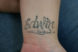 Laser tattoo removal female before 2