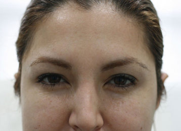 botox-female-after-3