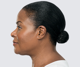 Kybella After Image First