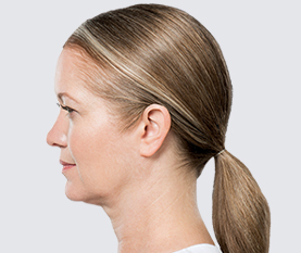 Kybella After Image Fourth