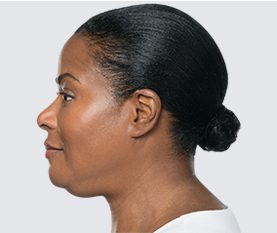 kybella Before Image First