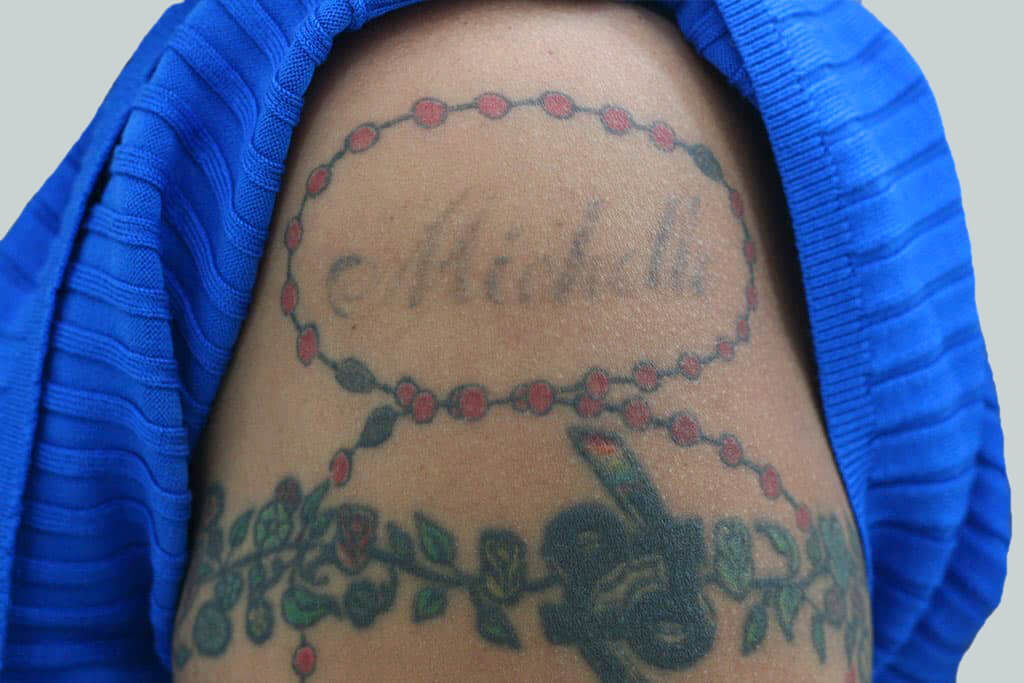 Eliminating your Tattoos with Disappearing Ink NYC | Visual.ly