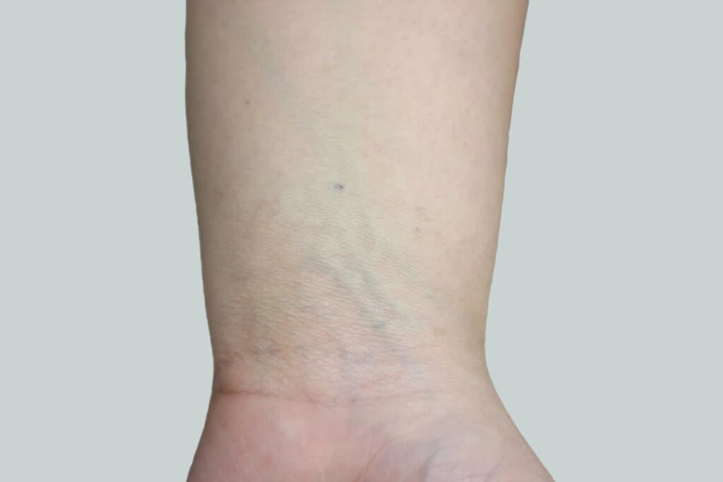 Does Tattoo Laser Removal Leave Scars  Pulse Light Clinic London
