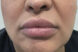 Juvederm Lips Injections After