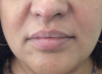 Juvederm Lips Injections Before