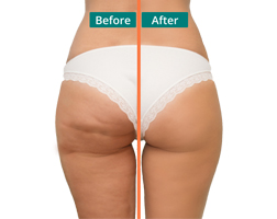 Aveli Cellulite Treatment