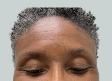 15146_female_dysport_forehead_before