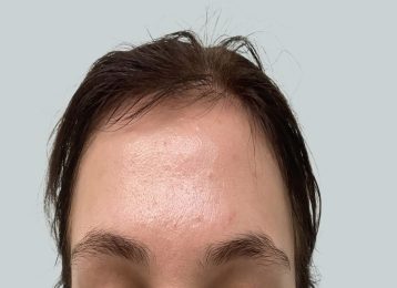 17402-co2-female-forehead-before