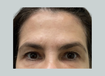 20158_undereye_filler_after-remove