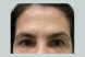 20158_undereye_filler_after-remove