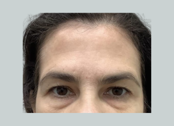 20158_undereye_filler_before