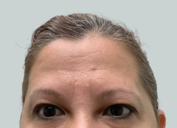 22478_female_dysport_forehead_after