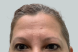 22478_female_dysport_forehead_after