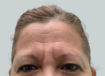 22478_female_dysport_forehead_before