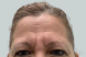 22478_female_dysport_forehead_before