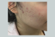 22697_female_pixel_scars_before