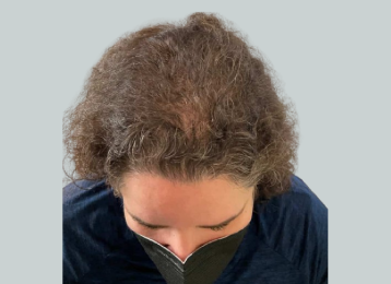 23064_PRP_hairloss_after