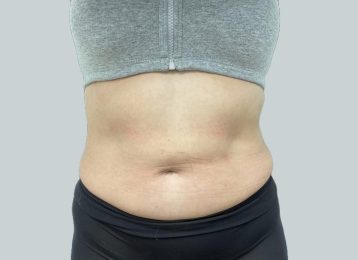 23858-coolsculpting-female-abdomen-after