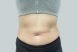 23858-coolsculpting-female-abdomen-after