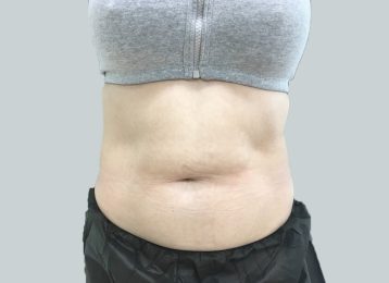 23858-coolsculpting-female-abdomen-before