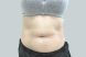 23858-coolsculpting-female-abdomen-before