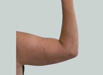 24842-coolsculpting-female-arm-after