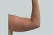 24842-coolsculpting-female-arm-after