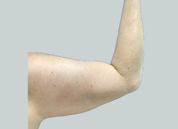 24842-coolsculpting-female-arm-before