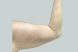 24842-coolsculpting-female-arm-before