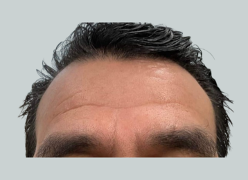 24929_male_dysport_forehead_after