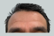 24929_male_dysport_forehead_after