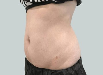 25050-medical-weightloss-belly-after