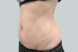 25050-medical-weightloss-belly-after