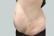 25050-medical-weightloss-belly-before