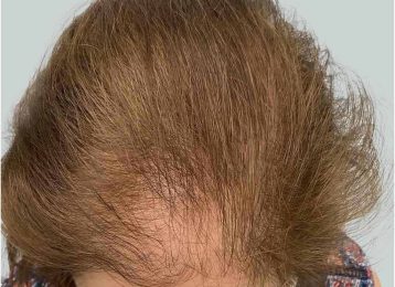 25147_microneedling_prp_hairloss_female_after