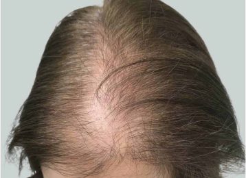 25147_microneedling_prp_hairloss_female_before