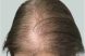 25147_microneedling_prp_hairloss_female_before