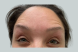 25589_female_dysport_forehead