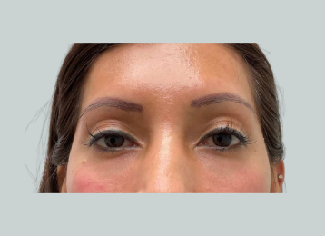 25675_undereye_filler_after