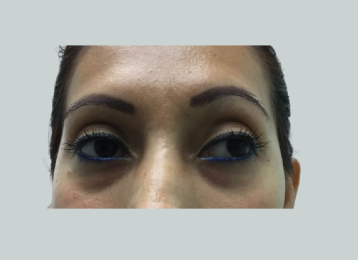 25675_undereye_filler_before