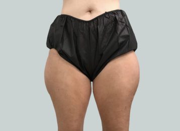 25846-coolsculpting-female-thighs-after