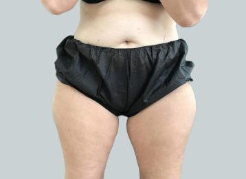 25846-coolsculpting-female-thighs-before