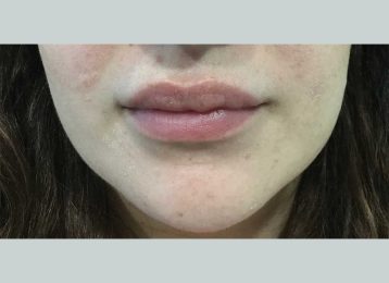 26197_lip_filler_before