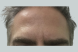 26621_male_dysport_forehead_after