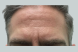 26621_male_dysport_forehead_before